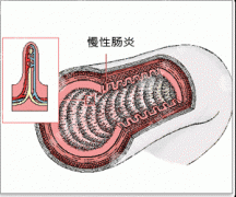 慢性肠炎百科