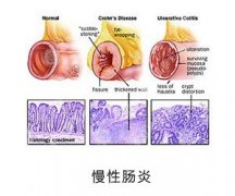 慢性肠炎的诱因以及治疗