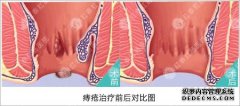 无锡治疗痔疮多少钱