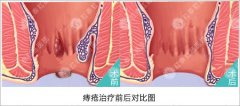 早期痔疮有哪些症状