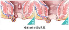 痔疮图片是什么样子