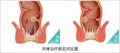 治疗内痔大概要多少钱
