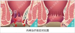内痔的主要症状是什么