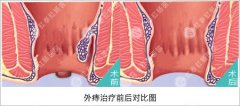 外痔的临床症状是什么