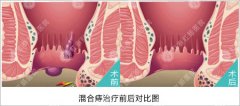 混合痔的症状表现是什么