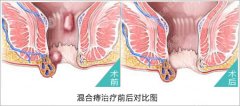 混合痔的症状图片