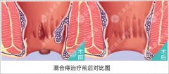 为什么会得混合痔呢