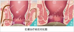 治疗肛瘘的费用是多少
