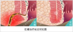 肛瘘初期图片