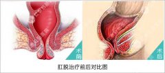 无锡治疗脱肛大概多少钱