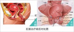 脱肛的主要症状是什么