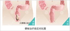 便秘治疗需要多少钱