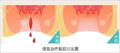 大便出血的症状是什么