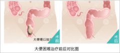 治疗大便困难需要多少钱