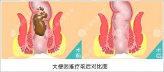 大便困难会有什么症状