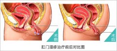 治疗肛门湿疹的费用