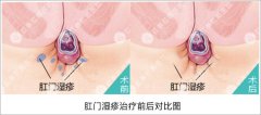 肛门湿疹的症状有啥