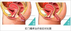 治疗肛门瘙痒的费用要多少