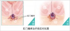 肛门瘙痒的症状有什么呢