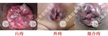 内痔外痔混合痔